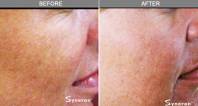 Chicago Laser Wrinkle Reduction